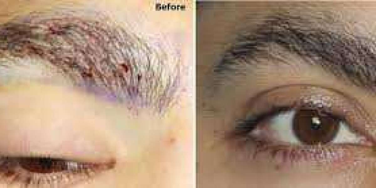 Male Eyebrow Transplant