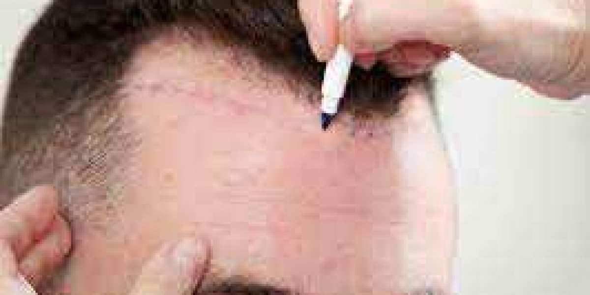 Fue Hair Transplant Palm Desert