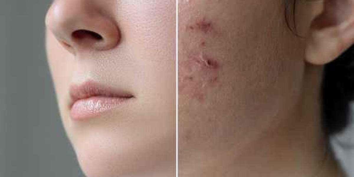 Get Rid Of Acne Scars And Blemishes