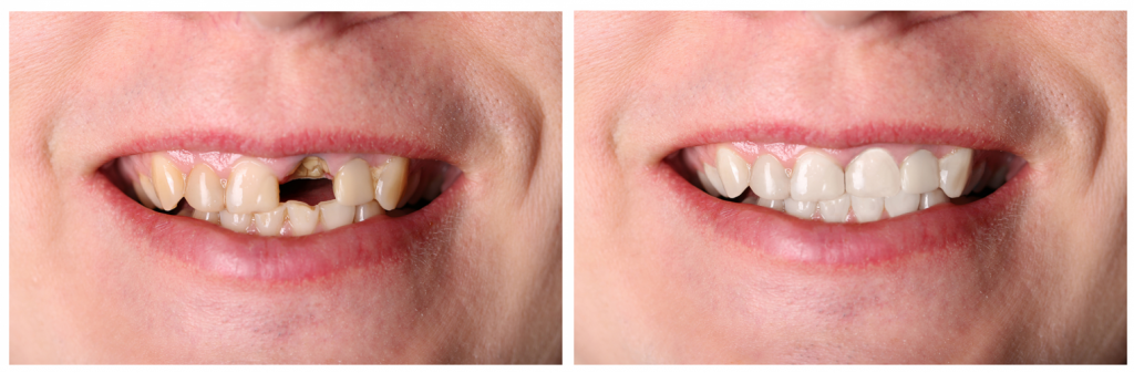 Dental implants near me | Dental Implants - Replace Missing Teeth | Dental Bridges