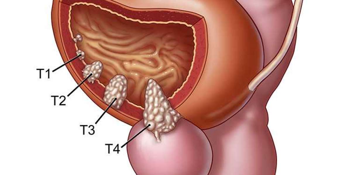 Bladder Problem In Men - The Prostate Connection