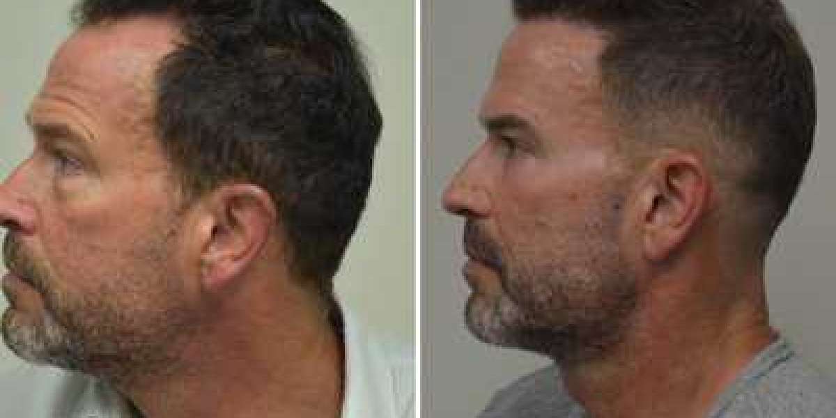 THE SUCCESS RATE OF THE FUE HAIR TRANSPLANT