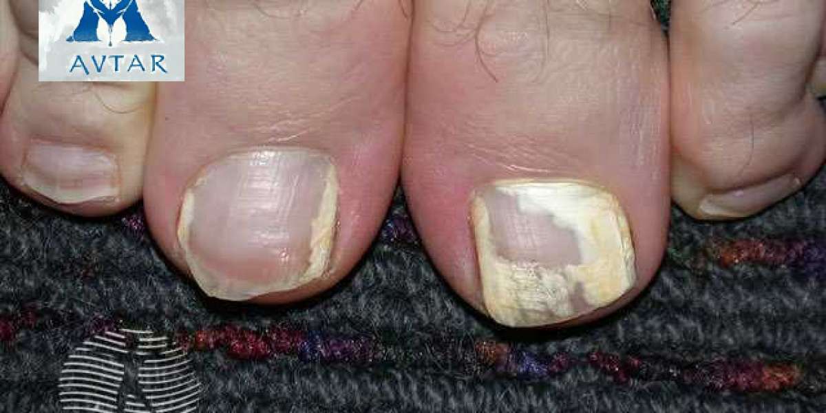 Loceryl Nail Lacquer Buy Online Nail Generic Medicine