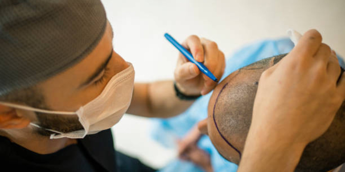 Combating Hair Loss: Comparing Hair Transplants with Other Treatments in Riyadh