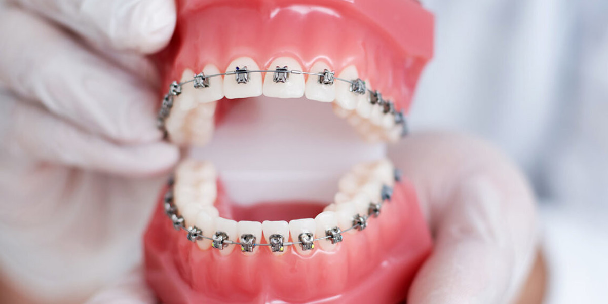 Dubai Dental Braces: Things You Should Know Beforehand