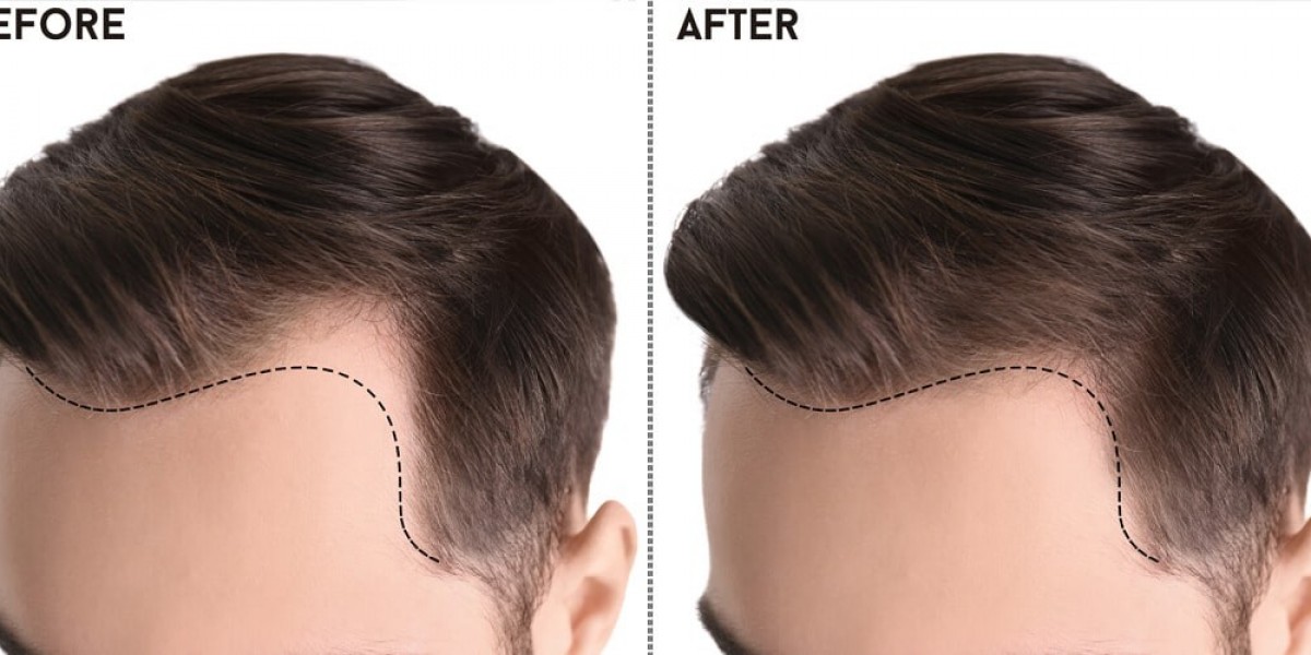 Navigating Hair Restoration: A Comprehensive Guide to Hair Transplants in Pakistan