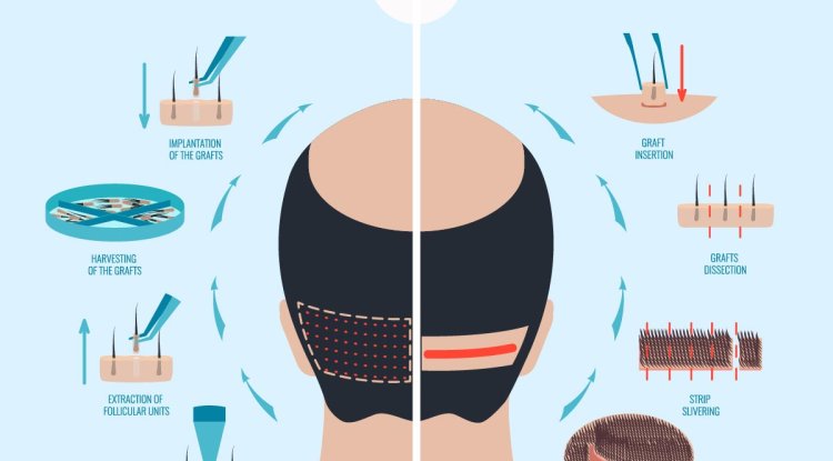 FUE vs FUT: Which Hair Transplant Technique is Right for You? - France Watcher