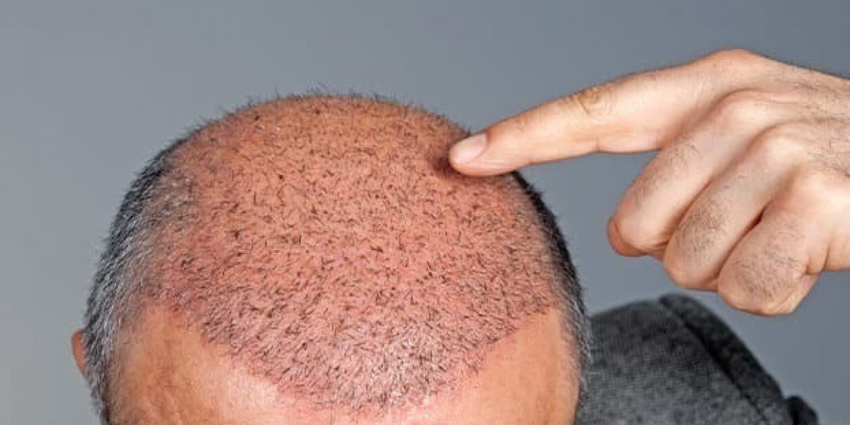 Redefine Your Look with Advanced Hair Transplant in Islamabad