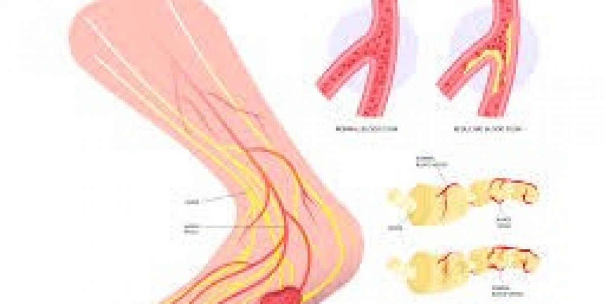Can Gabapentin 600mg Help Manage Diabetic Neuropathy Pain?