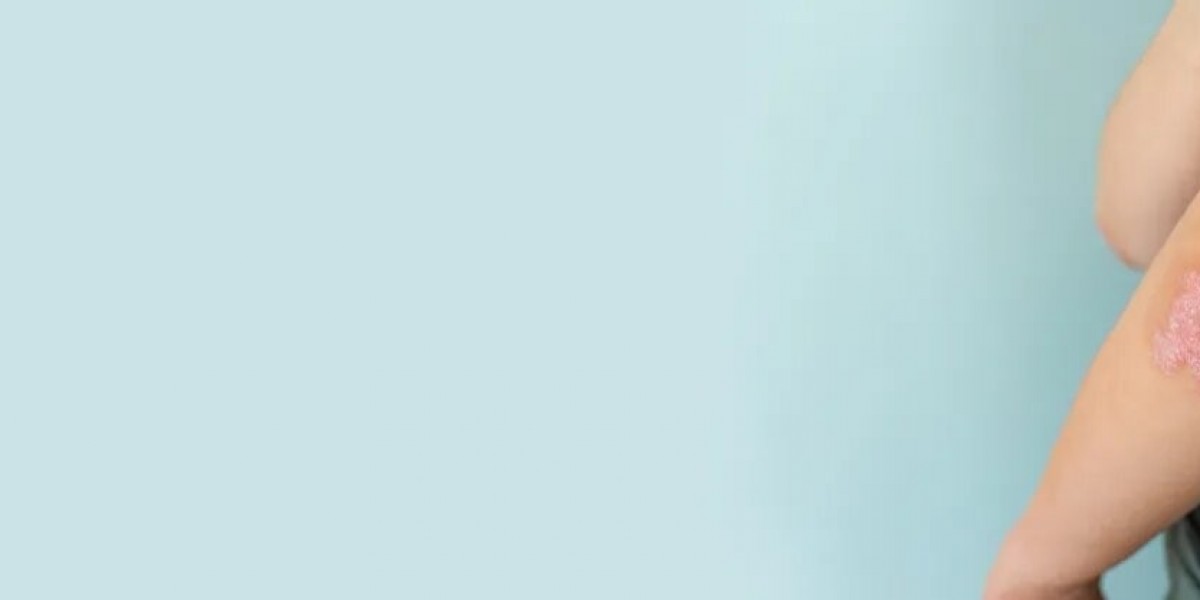 How is Psoriasis Treated?