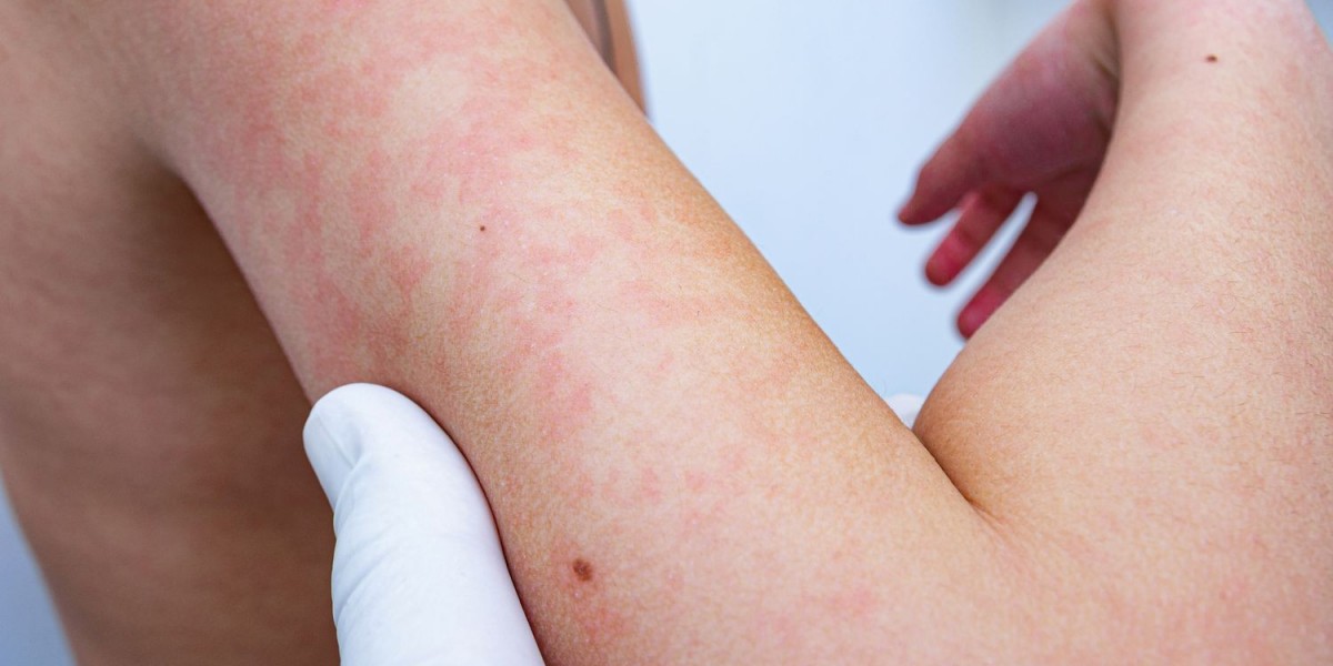 Heat Rash – Treatments, Symptoms and Causes