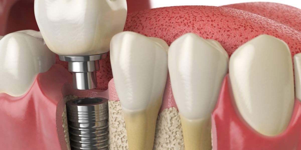 Same-Day Implants for Busy Professionals: Why They’re Ideal