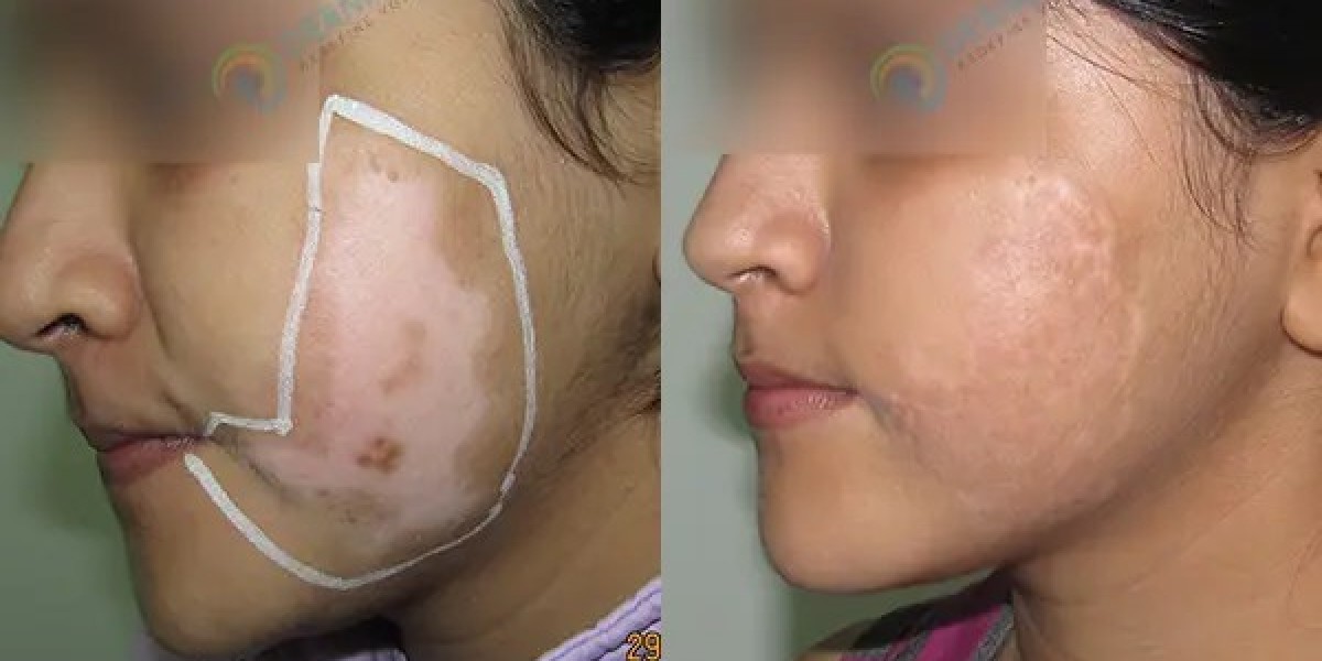 Successful Vitiligo Treatment in Delhi Renew Your Skin