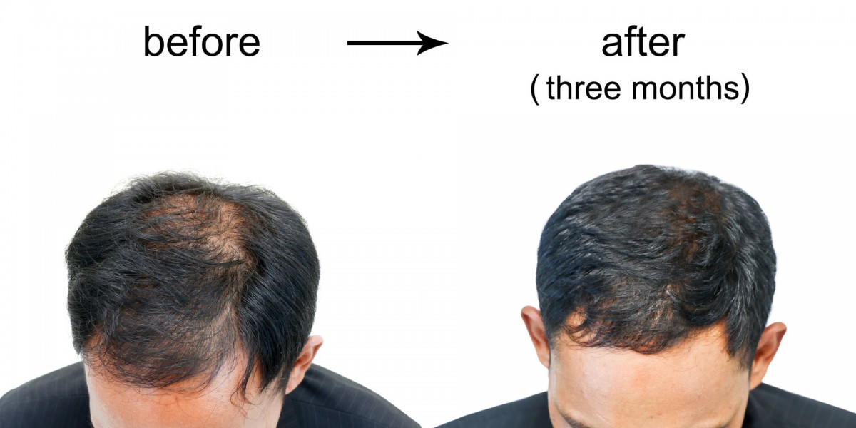 Regrow with Confidence: Your Guide to Finding the Right Hair Loss Treatment Near You