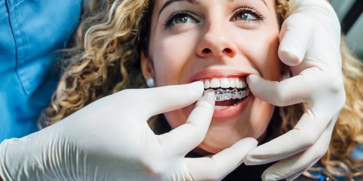 Do Aligners Cause Cavities? What You Need to Know