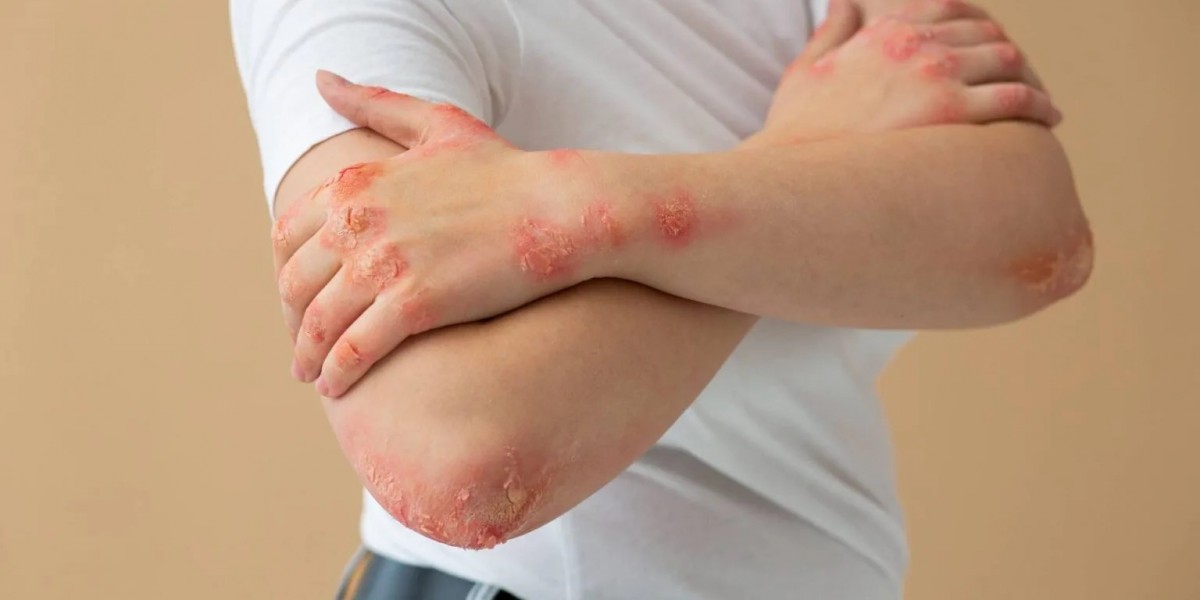 Psoriasis Treatment in Delhi Best Dermatologist in South Delhi
