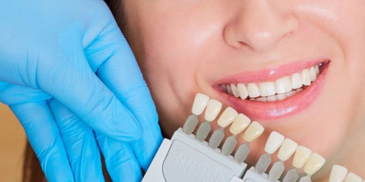 Are Composite Veneers Suitable for Teens? What Parents Should Know