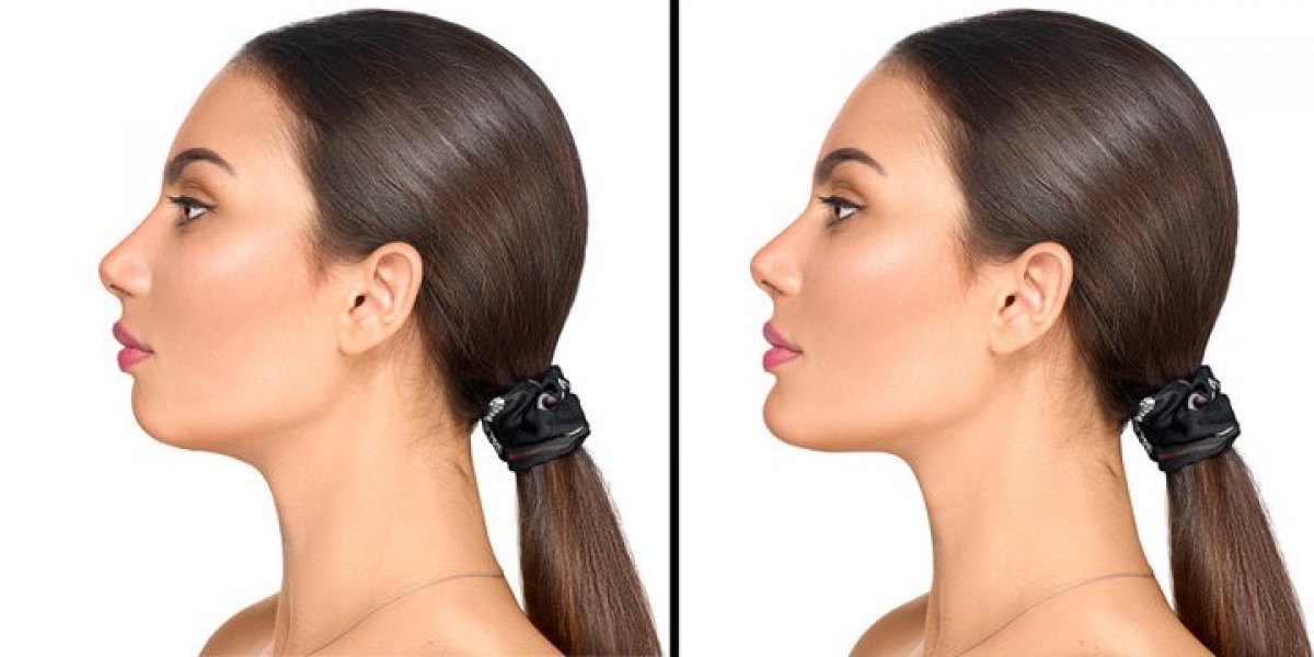 Best Clinics for Chin Reduction in Islamabad: What to Look For Before You Decide