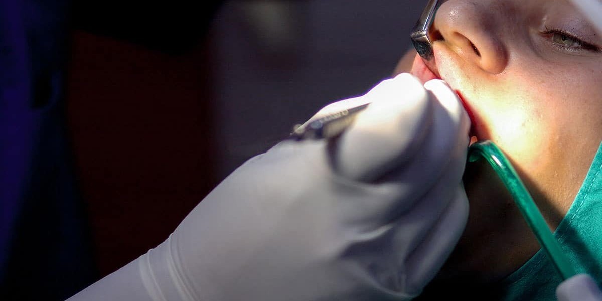 Affordable Root Canal in Islamabad: Where to Go
