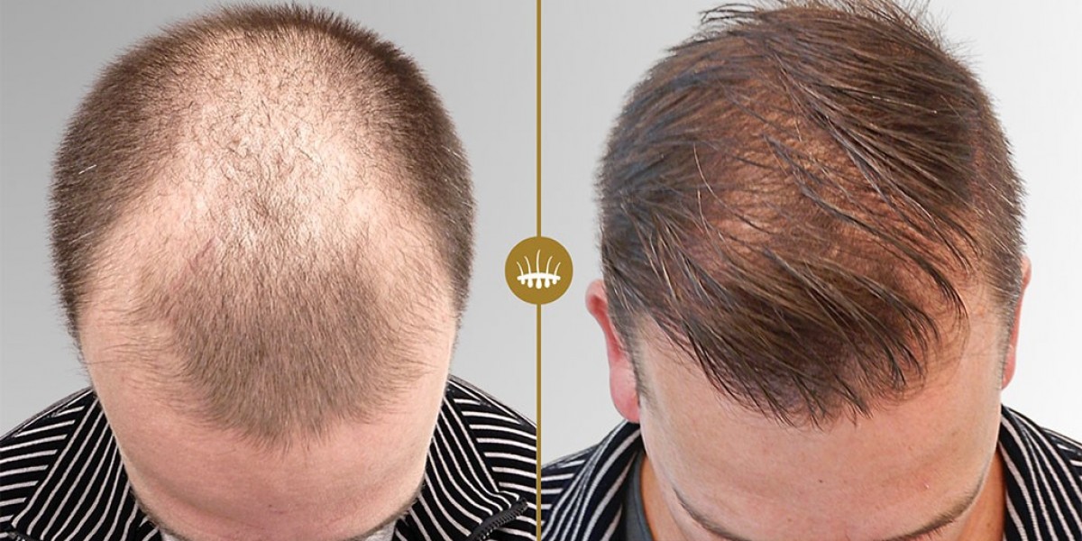 Dr. Naveed Honest Approach to Hair Transplant Results