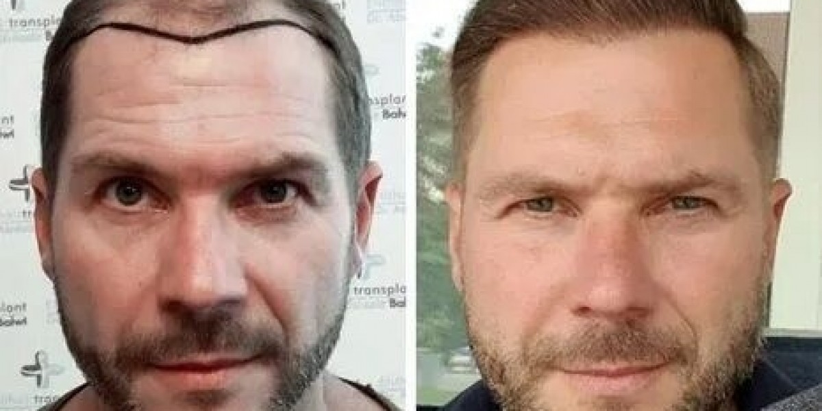 Hair Transplant in Islamabad – Your Path to Natural Hair Restoration