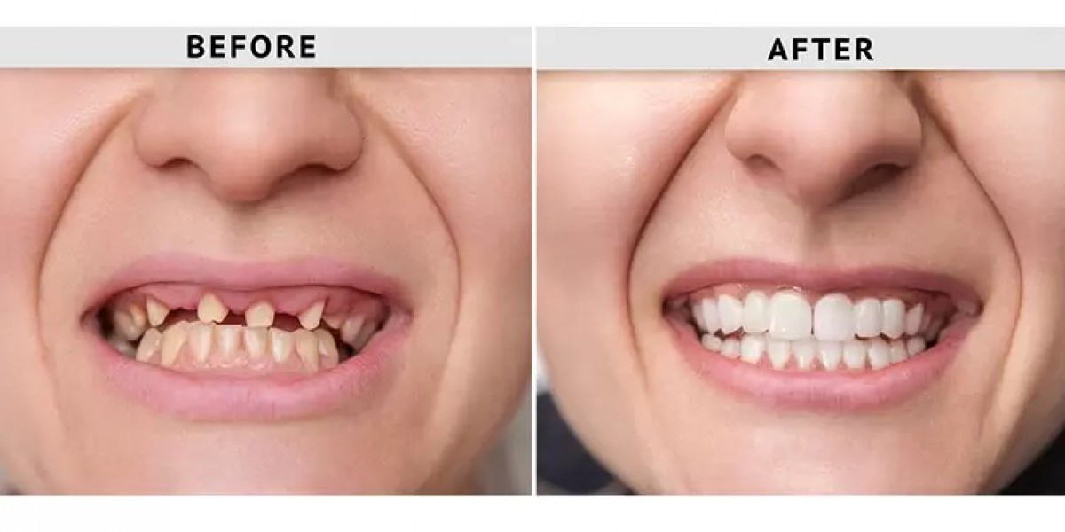 Restoring Function and Beauty with Dental Crown Bridges