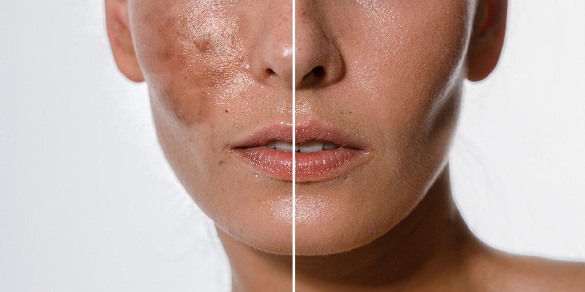 Reveal Your Radiant Glow with Skin Whitening Treatment in Islamabad