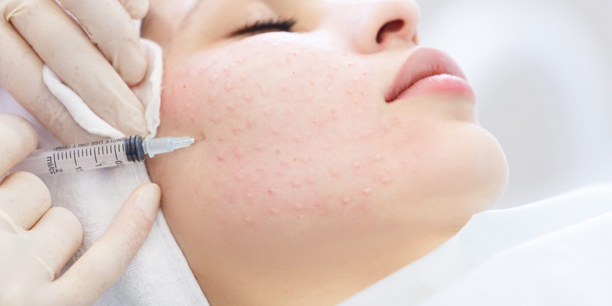 Mesotherapy and Sun Damage: Healing Your Skin from Within