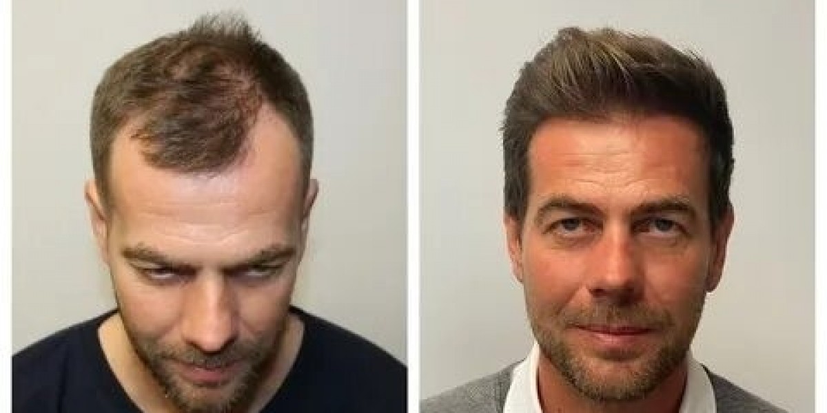 Hair Transplant in Islamabad – Modern Solutions for Lasting Confidence