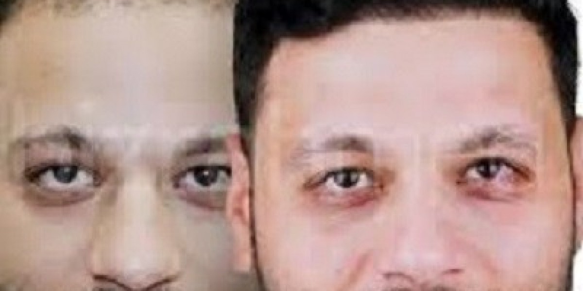 Your Step-by-Step Hair Transplant Journey in Riyadh