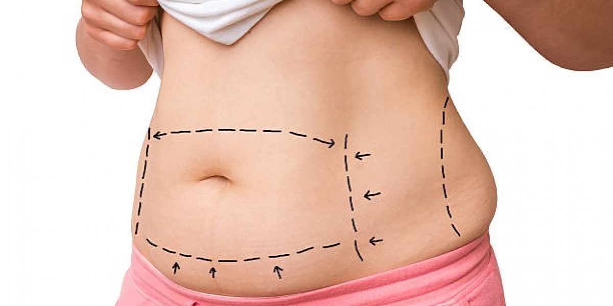 How to Prepare Your Body for a Successful Lipo Abdominoplasty