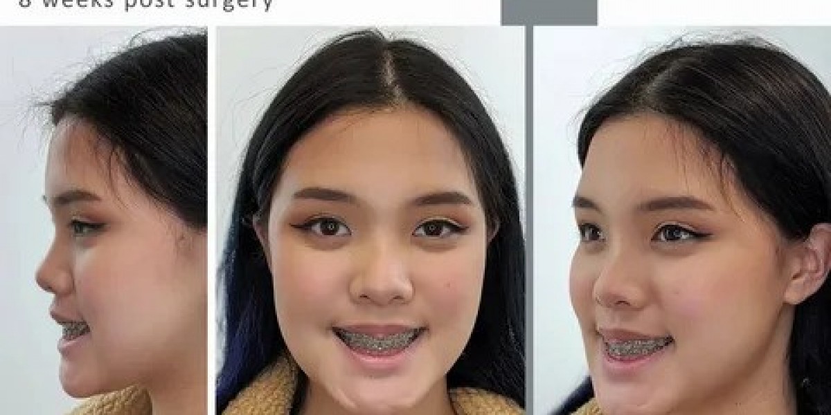 Jaw Surgery in Islamabad: Everything You Need to Know