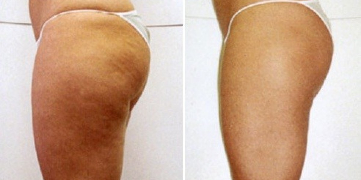 EMTONE Treatment in Clermont, FL | Advanced Med Spa Care