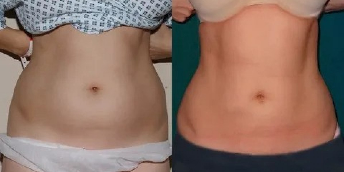 Thinking About Liposuction in Islamabad You Should Know This