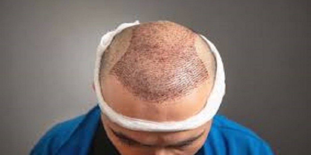 Top Benefits of Getting a Hair Transplant in Riyadh