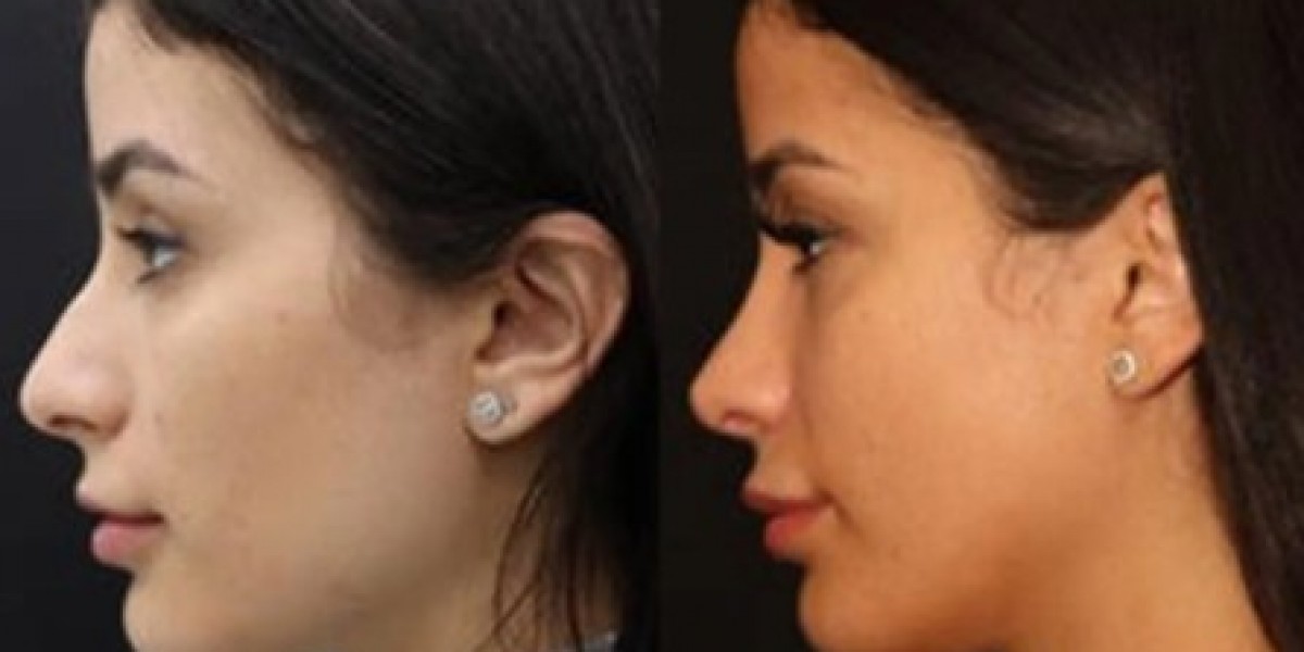 The Benefits of Rhinoplasty in Regard to the Appearance and Breathing.