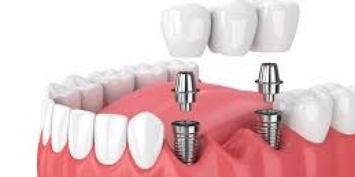 The Importance of Choosing an Experienced Implant Dentist