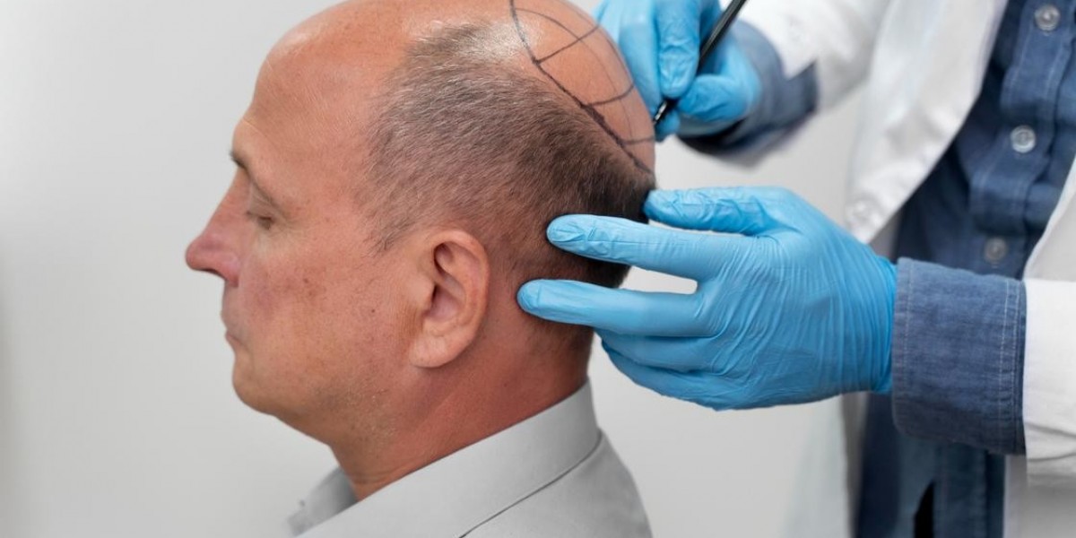 Regain Natural Hair and Confidence with an Advanced Hair Transplant in Islamabad