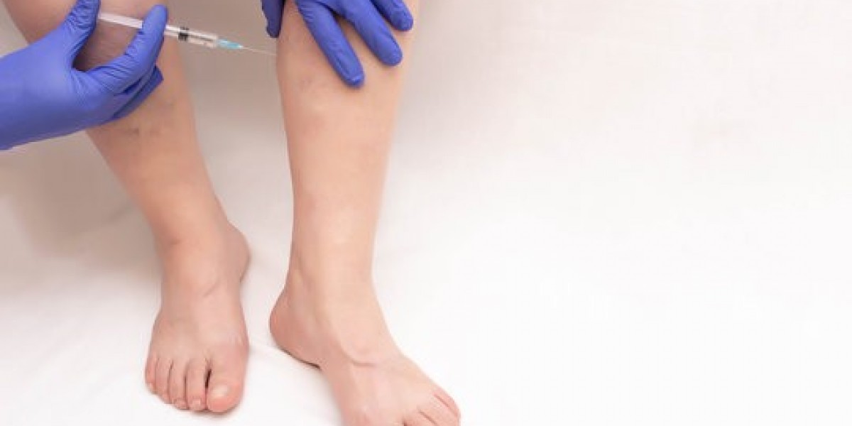 Best Time to Get Spider Veins Treatment in Islamabad