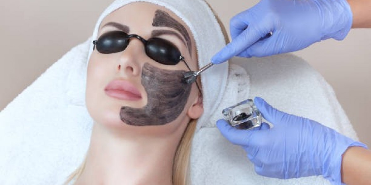 Top 10 Reasons to Choose Laser Carbon Peel in Islamabad