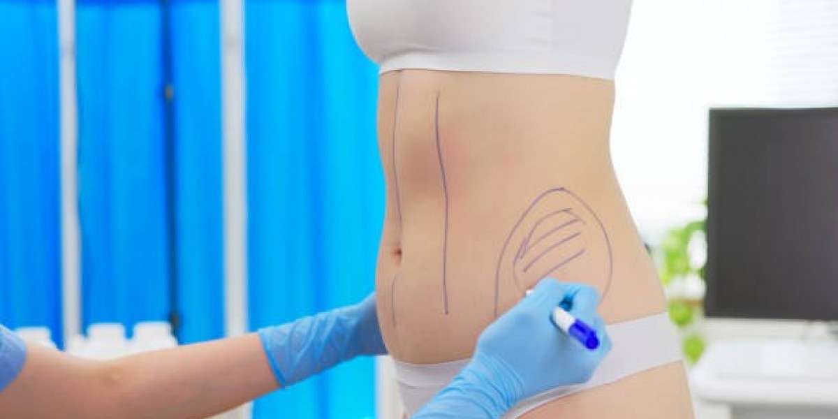Liposuction Surgery in Dubai - Body Contouring Made Easy