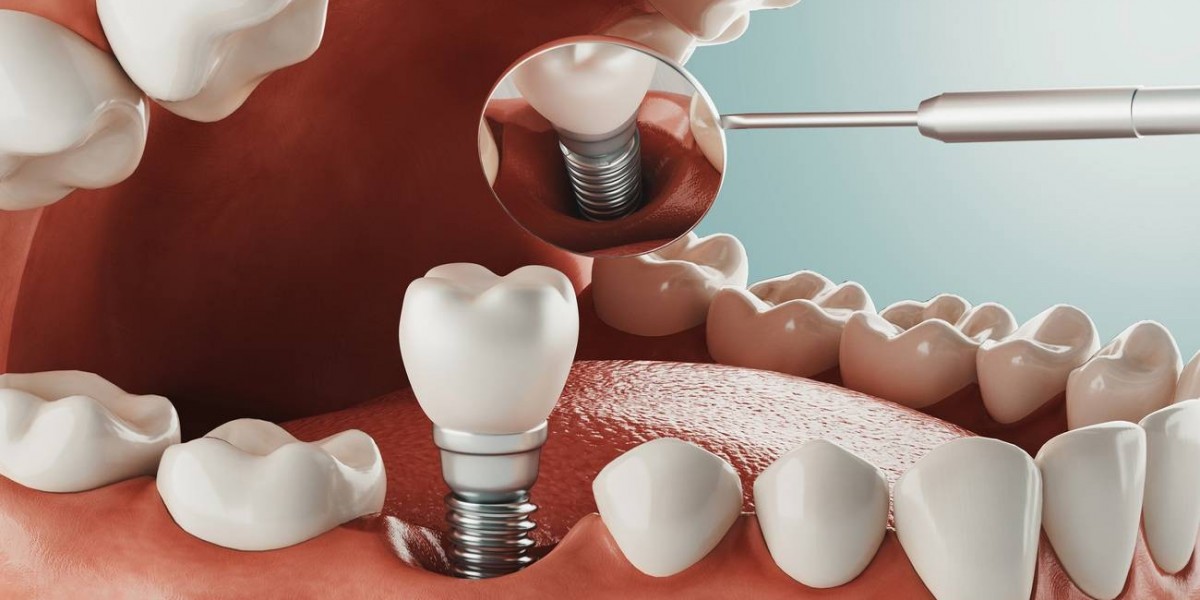 How to Prepare for Your Dental Implant Surgery: A Complete Patient Guide