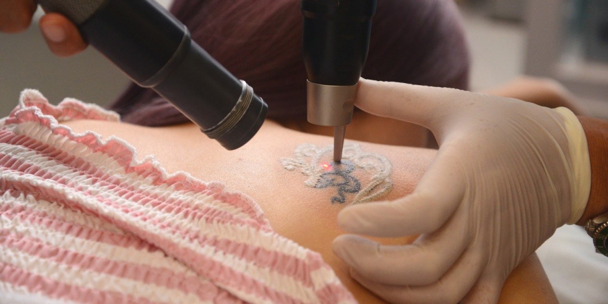 Tattoo Removal for Professional Reasons in Islamabad