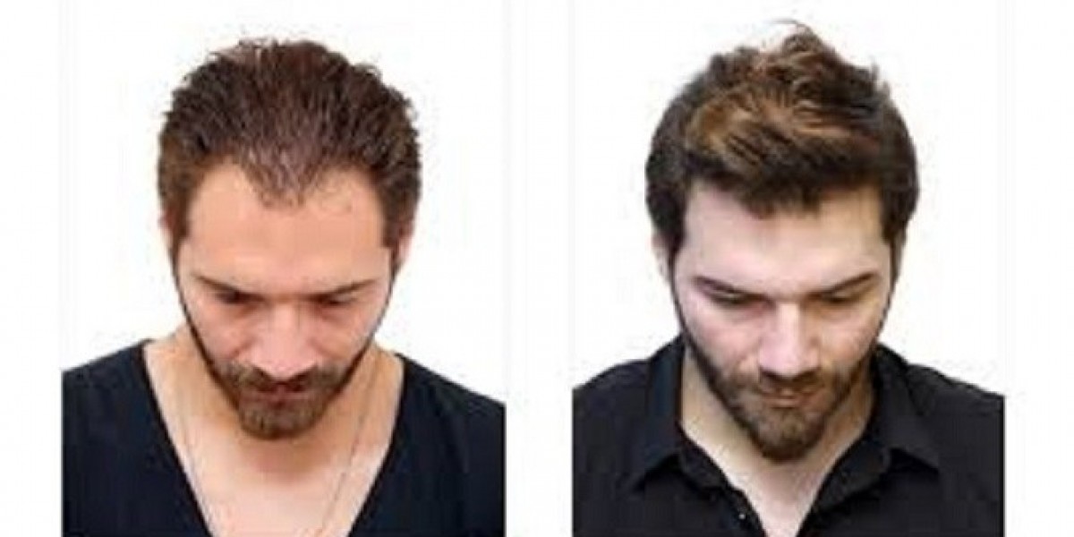 ? أفضل عيادات زراعة الشعر في الرياض لعام 2025 – اختَر الأنسب لك