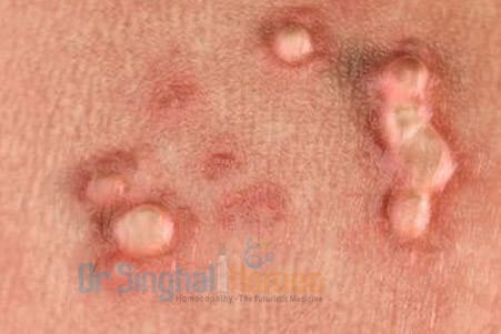 Best Homeopathic Treatment for HPV & Genital Warts