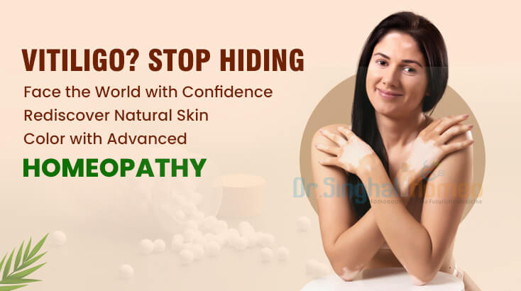 Top 5 Homeopathic Medicine for Vitiligo– How It Can Help?