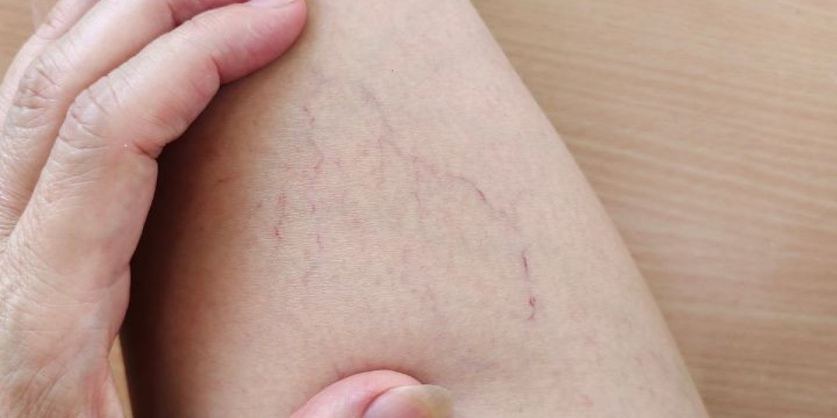 What Is the Best Time to Seek Treatment for Varicose Veins?