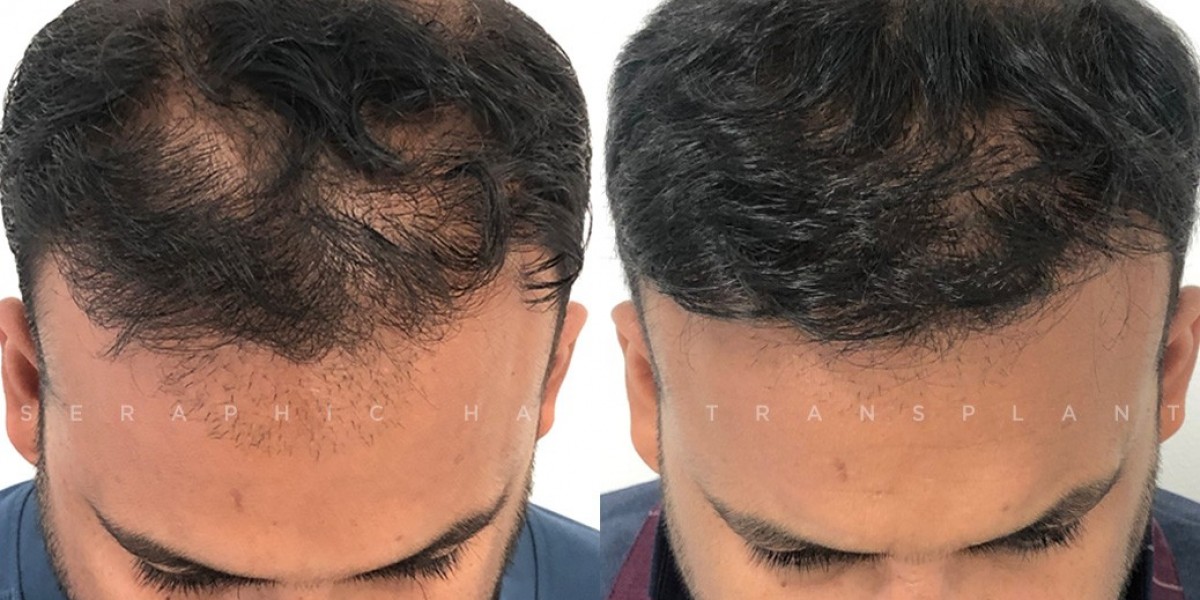 Indore Hair Doctor – Expert Hair Restoration for a Confident You