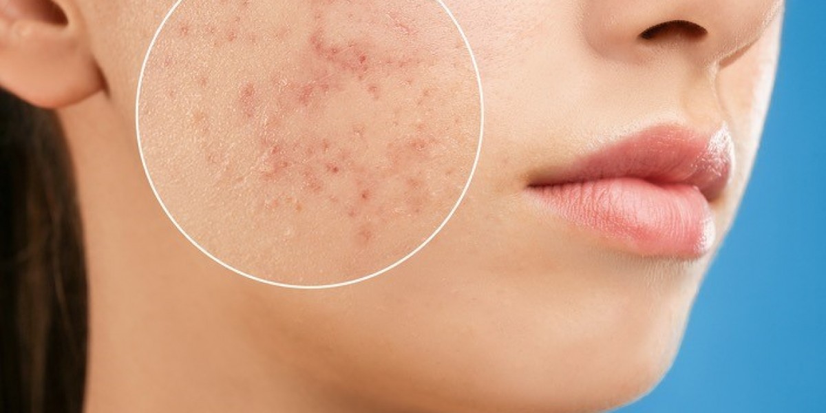 Acne Scar Removal Dubai: Innovative & AI-Assisted Techniques