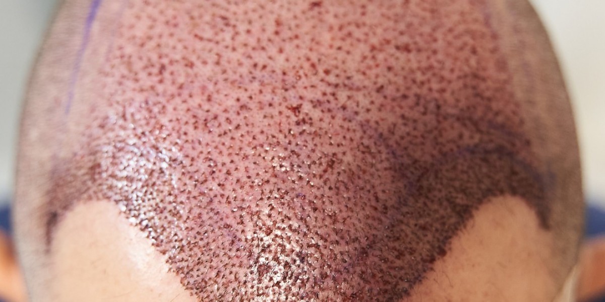 Is Hair Cloning Permanent in Dubai Expert Insights